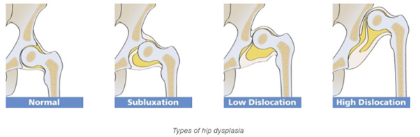 Types of hip dysplasia
