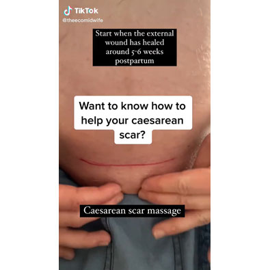 Caesarean Scar Massage To Promote Healing